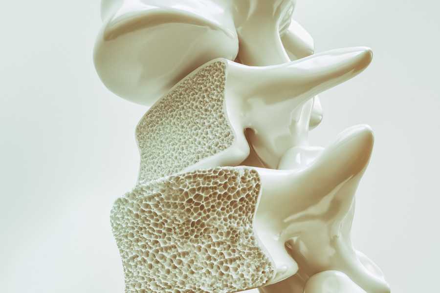 osteoporose-tudo-que-voce-precisa-saber-para-tratar-e-prevenir